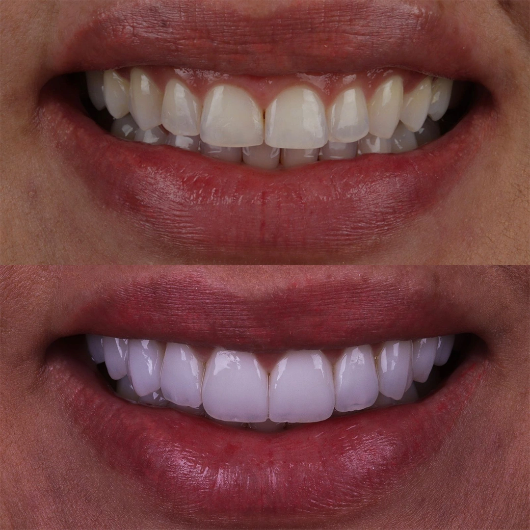 Antes e Depois - 01