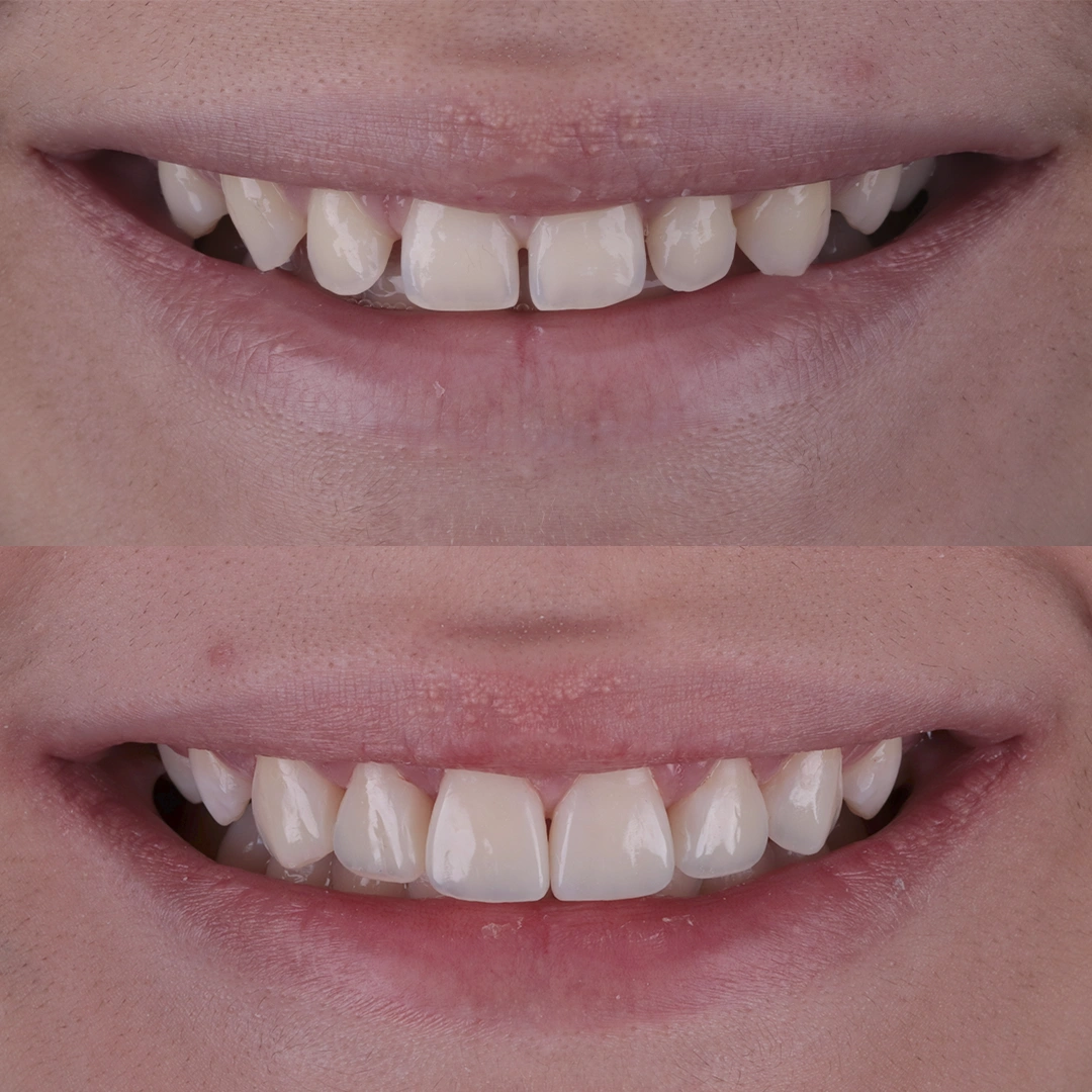 Antes e Depois - 02