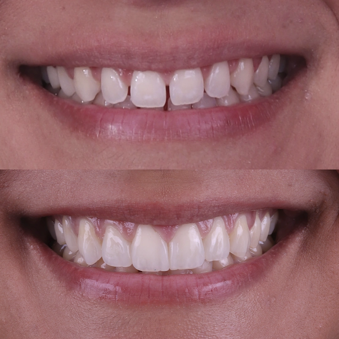 Antes e Depois - 03